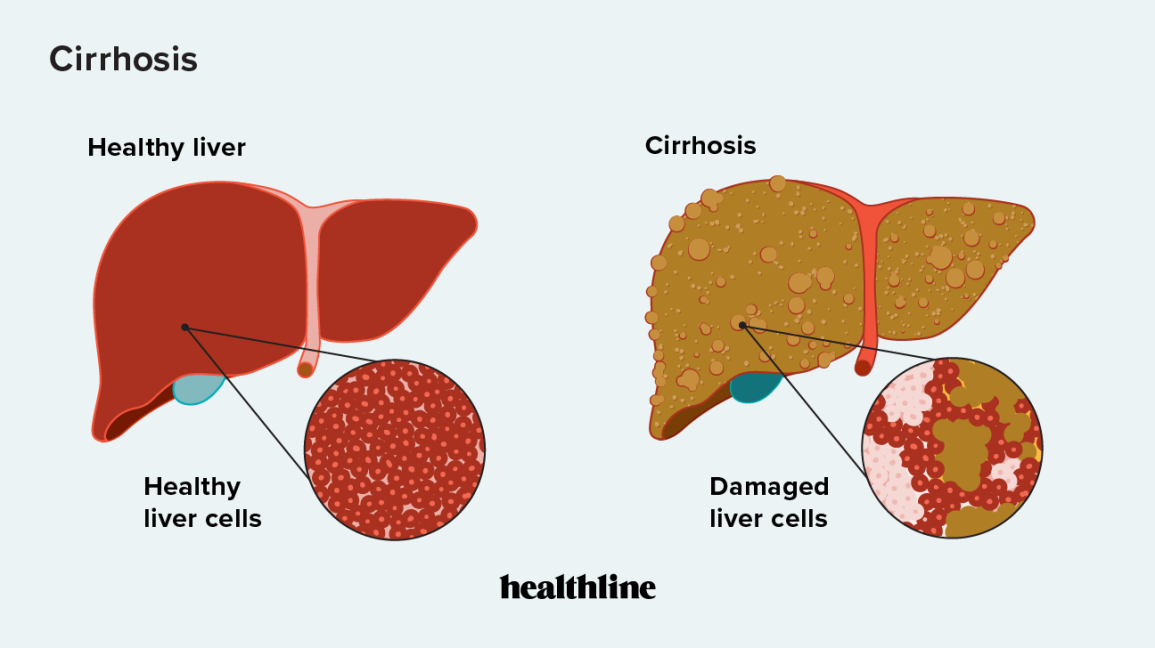 liver disease diagnosis through blood tests