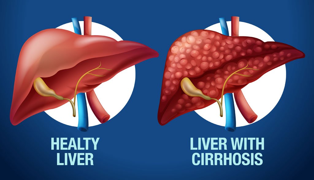 liver disease diagnosis in cirrhosis