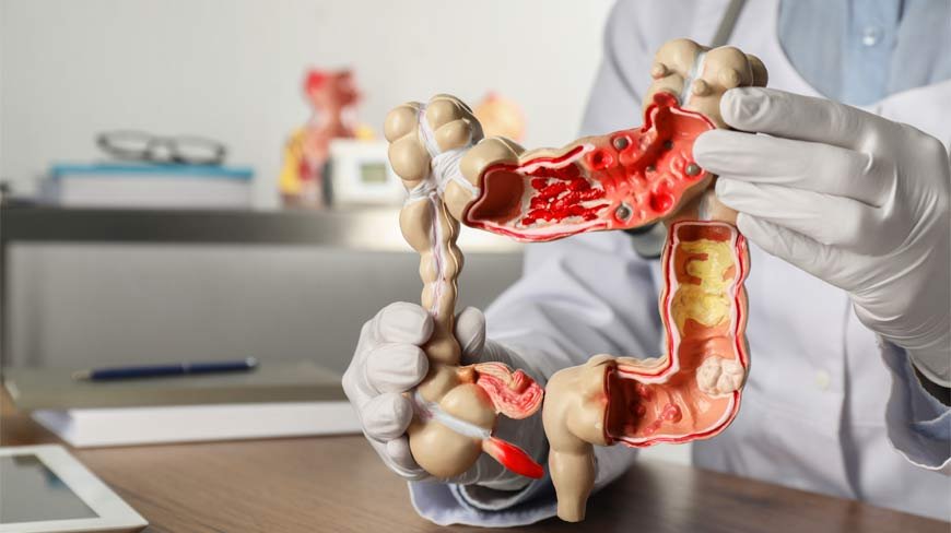 Colonoscopy importance for early detection