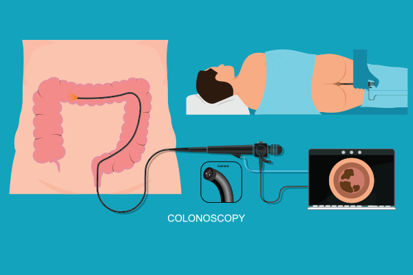 Colonoscopy importance in digestive symptoms