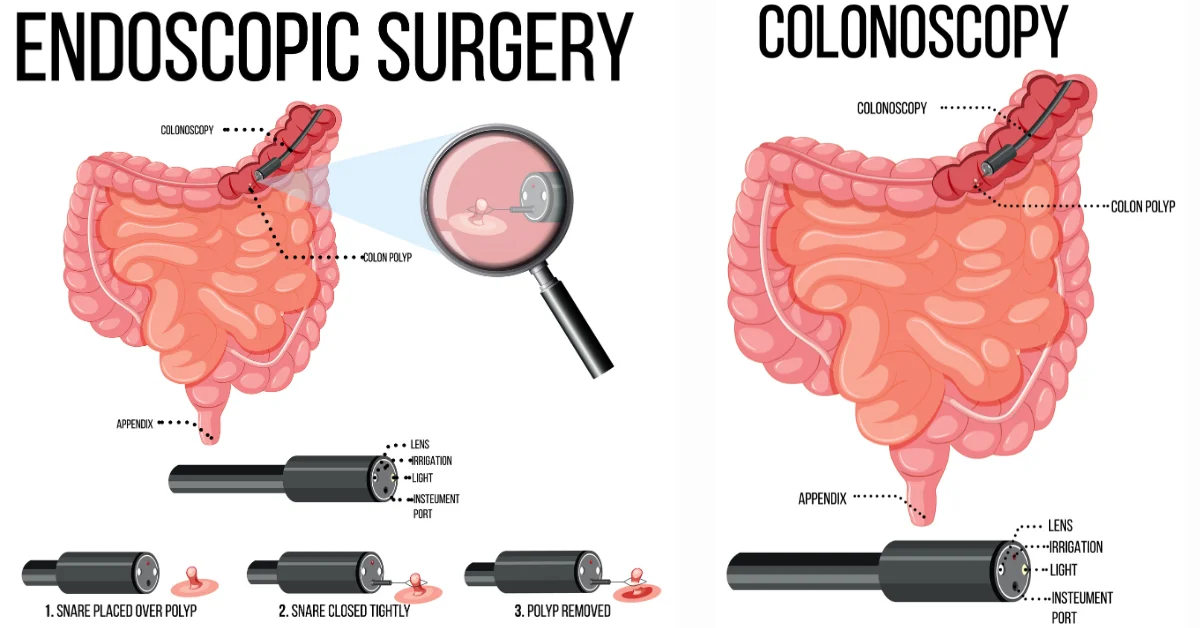 endoscopy vs colonoscopy