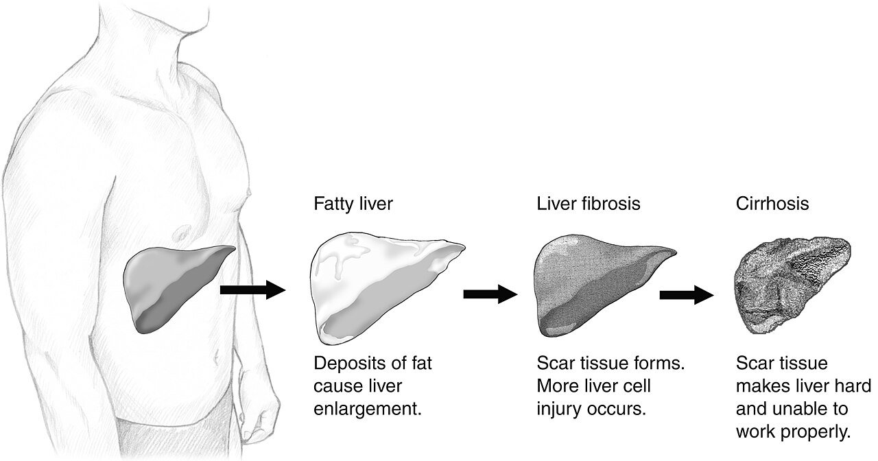 Why Fatty Liver Gets Missed for So Long