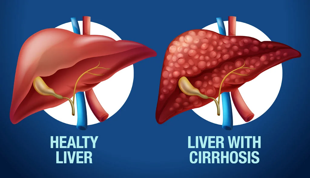 liver disease diagnosis in cirrhosis